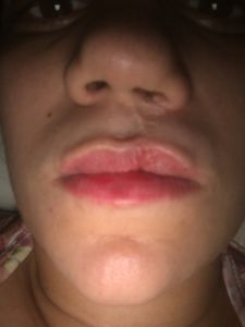 Correção do meu lábio e nariz leporino
