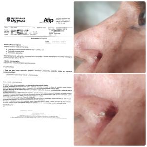 Tratamento de Câncer