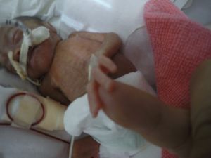 Minha Bebê nasceu de 22 semanas com 444 gramas