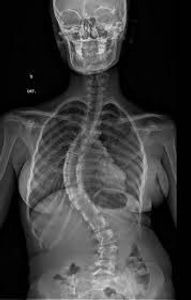 Cirugia de escoliose da Dany