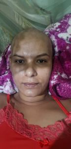 Ajuda para o tratamento da Cineide 