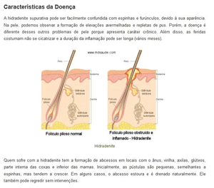 ajuda para Cirurgia Hidradenite supurativa