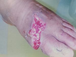 CIRUGIA PARA TIRAR A TALA DO DEDÃO DO PÉ