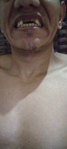 Olá sou Evandro Viana barroso criei essa vakinha para arrecadar 3,000,00 para poder colocar minha prótese dentária pois estou sem condições financeiras 