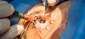 Cirurgia de Catarata da Lourdes 