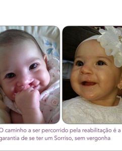 Mamadeiras de bico de colher para sorrisos fissurados com amor 