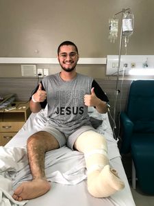 TRATAMENTO PARA HEMIMELIA FIBULAR BILATERAL