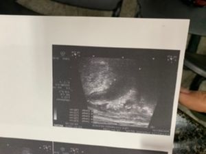 Realizar a cirurgia da apêndice 