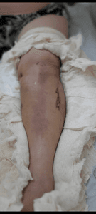 Cirurgia de quebradura e artrose