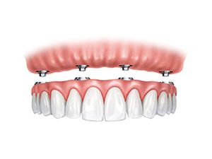 Ajuda para conseguir pagar prótese procoloco 