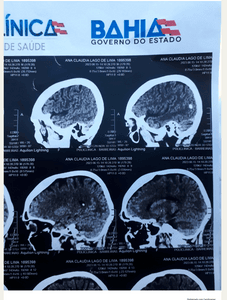Ajude Cláudia a Vencer o Nódulo Cerebral