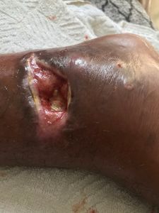 Eu Marcos Vinicius peço a ajuda de vcs , pois estou desempregado com família e sem condições de trabalhar devido está em situação complicada após ter caído da laje a trabalho . 