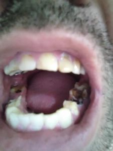 Compra de prótese dentária e enxerto ósseo