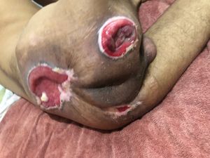 Tenho úlcera de pressão a mais de 15 anos.só vivo deitado em uma cama.não aguento ficar 10 minutos sentado sem dor e soar..queria poder fazer essa cirurgia pra melhorar minha vida,queria poder andar na rua e comer na mesa um dia ..