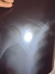 Estou com desgaste no ombro direito e preciso de ajuda