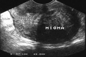 Operação de miomas da minha mãe urgente 