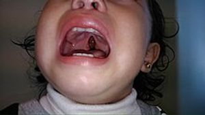 Tratamento pós cirurgia de fenda palatina 