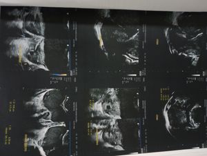 Aguardando a cirurgia