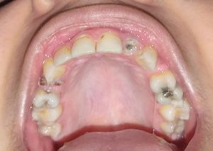 Preciso de implantes dentários urgente