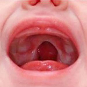 Vaquinha Online - Tratamento pós cirurgia de fenda palatina 