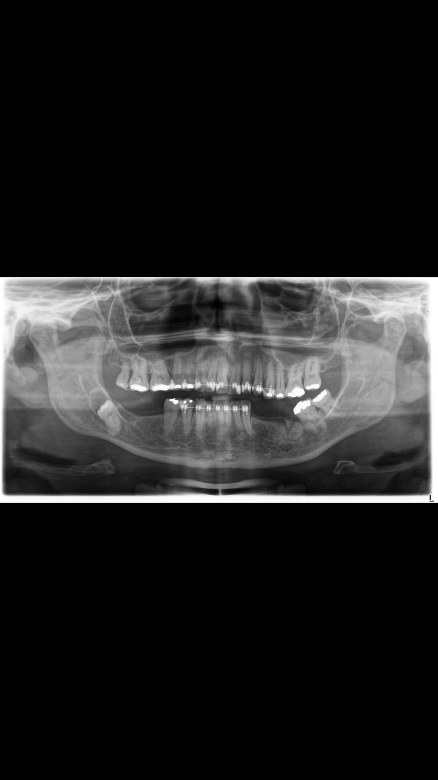Preciso fazer uma cirurgia pra retirar um cisto no dente siso e implantar os que faltam