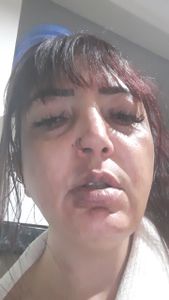 Vaquinha Online - Acidente de carro com necessidade de cirurgia 