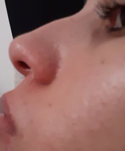 Dia de Doar - Cirurgia de desvio de septo nasal