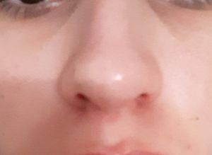 Vaquinha Online - Cirurgia de desvio de septo nasal